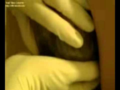 Pengobatan impotensi di Murmansk Nyeri testis sebagai efek pada potensi