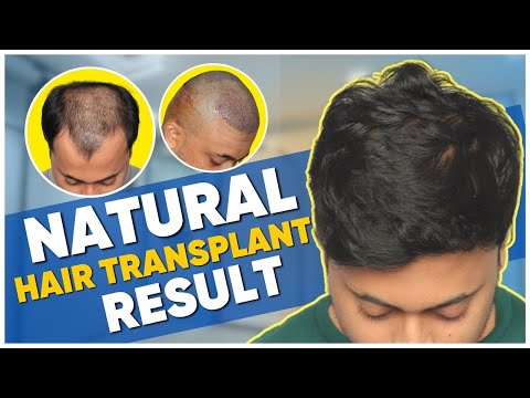 Hair Transplant in Thailand | Best Results & Cost of...