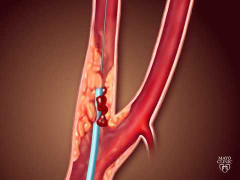 Voyage Through the Veins: An Animated Exploration of Carotid Angioplasty and Stenting