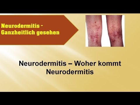 Die Behandlung der Schuppenflechte hinter dem Laser Als wylitschit das Ekzem auf den Händen