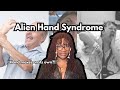 Alien Hand Syndrome Explained Neuroscience AJTheScienceGay