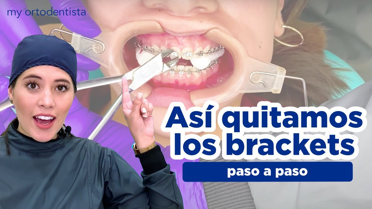 COMO SE QUITAN LOS BRACKETS/PASO A PASO