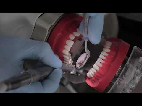 PFM Crown Prep #3 (chamfer margin) - Dr. Mark R. Taylor