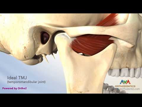 TMJ Disorder or TMD - Clicking and Closed Lock