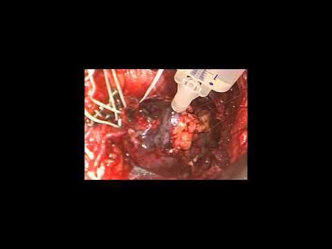 Partial Nephrectomy with Removal of Renal Tumor - Case B