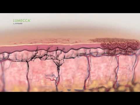 Lumecca IPL for Skin Rejuvenation - How It Works