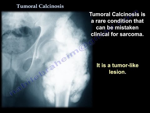 Tumoral Calcinosis - Everything You Need To Know - Dr. Nabil Ebraheim