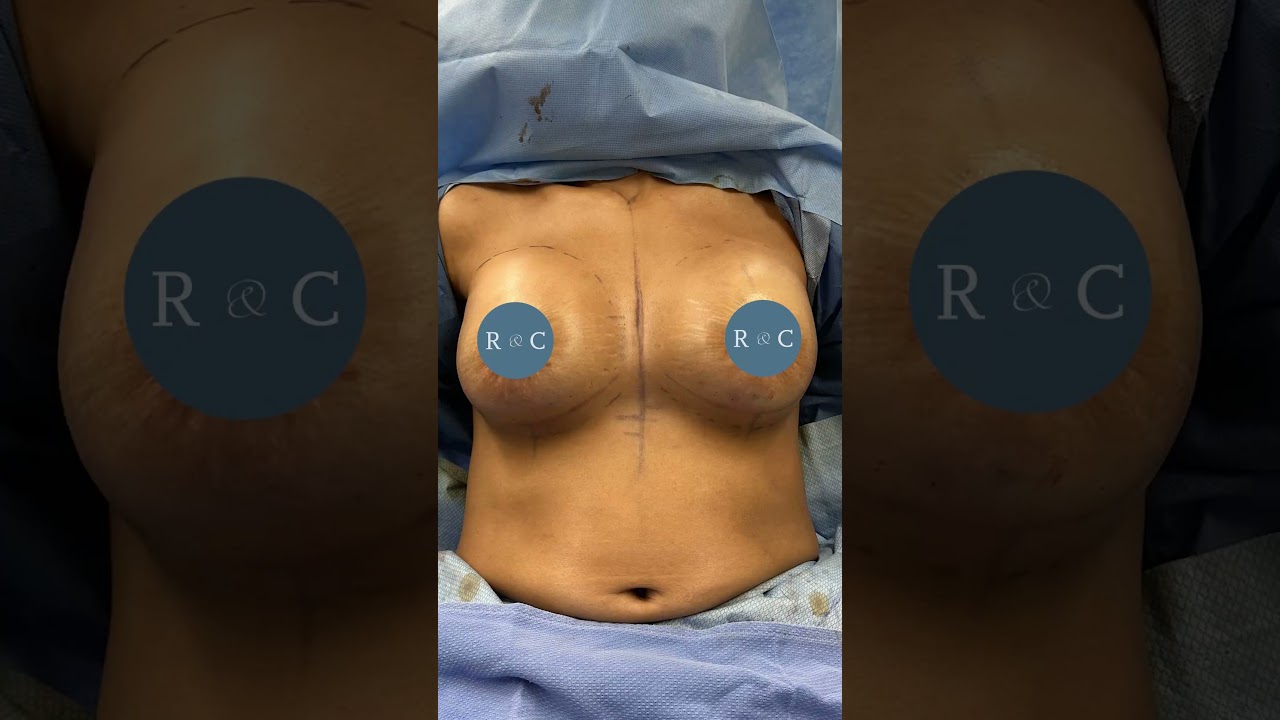 Mastering Elegance: Breast Augmentation & Lift with Dr. Francis at Ranch and Coast Plastic Surgery!