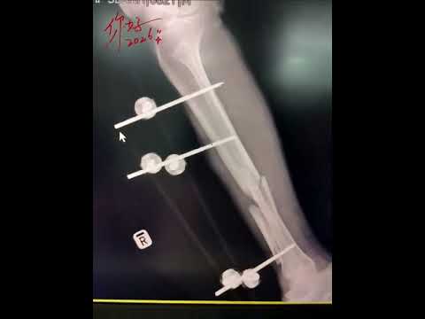 Robotic Walking Assist Device