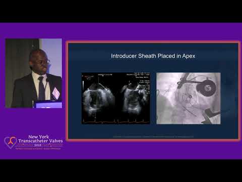 APOLLO TMVR Trial Update - Dr.  Anelechi Anyanwu