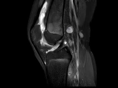 Septic arthritis of knee (joint infection).