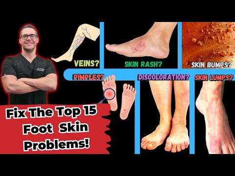 , title : 'Top 15 Foot Skin Problems [Toenail Fungus, Dry Skin & More]'
