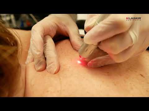 K-Laser Blue Derma - Multiple Seborrheic Keratosis on the Back & Abdomen - Carly Whytcross