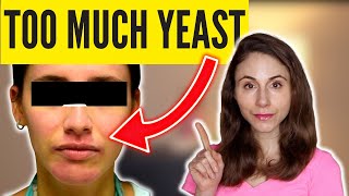 6 SIGNS OF TOO MUCH YEAST *SKIN* @DrDrayzday