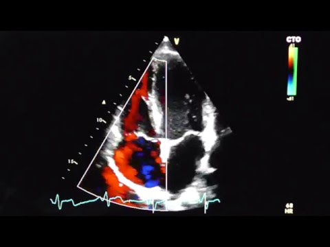 Behandlung einer hypertensiven Krise durch Nasenbluten kompliziert Klassifizierung von hypertensive Krankheit Präsentation