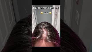 Bald spot regrowth update #femalehairloss #hairregrowthjourney