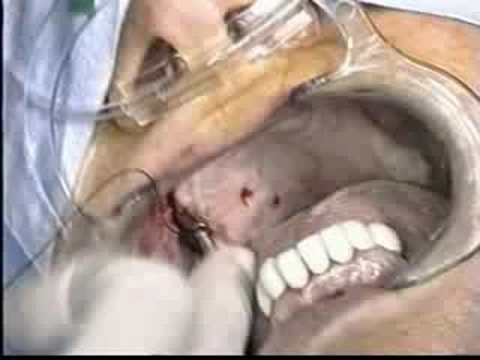 Dental Implants Posterior Maxilla