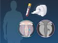 PSA And MRI Prostate Cancer Screening NEJM