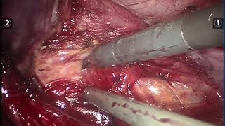 Robotic excision of rectovaginal endometriosis (shave)