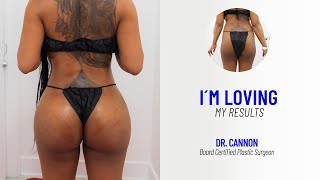 Snatched & Loving It: Her Skinny BBL Journey with Dr. Cannon