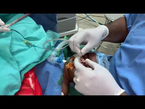 Extubation Or Removal Of The Rae Endotracheal Tube After Cleft Repair With Rockets