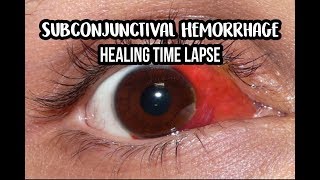14 Days Healing Time Lapse: Broken Blood Vessel in Eye (Subconjunctival Hemorrhage)