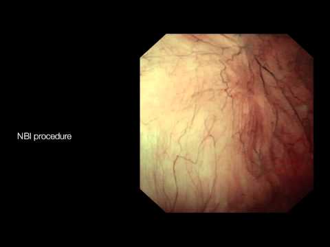 Conjunctival papilloma causes
