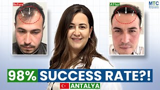Hair Transplant in Antalya 2025: DHI vs FUE, Costs, Recovery & Real Patient Reviews!