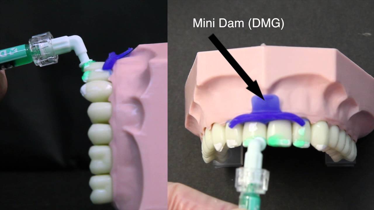 ICON Treatment Tutorial