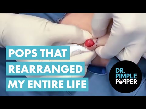 Different Shades of Butter! Dr Pimple Popper's Pops That Rearranged My Entire Life