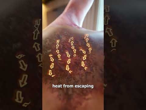 Common Burn Treatment Myths 😏