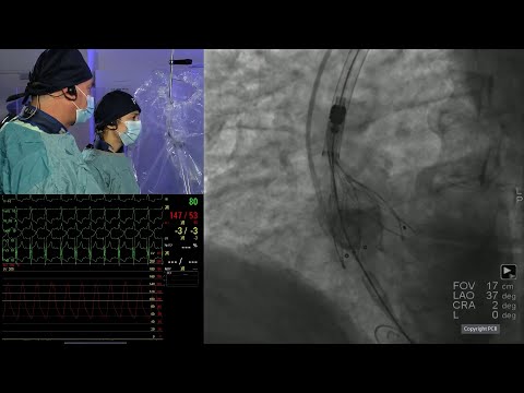 The index valve matters: optimal index TAVI for a lifetime of possibilities - PCR London Valves 2025