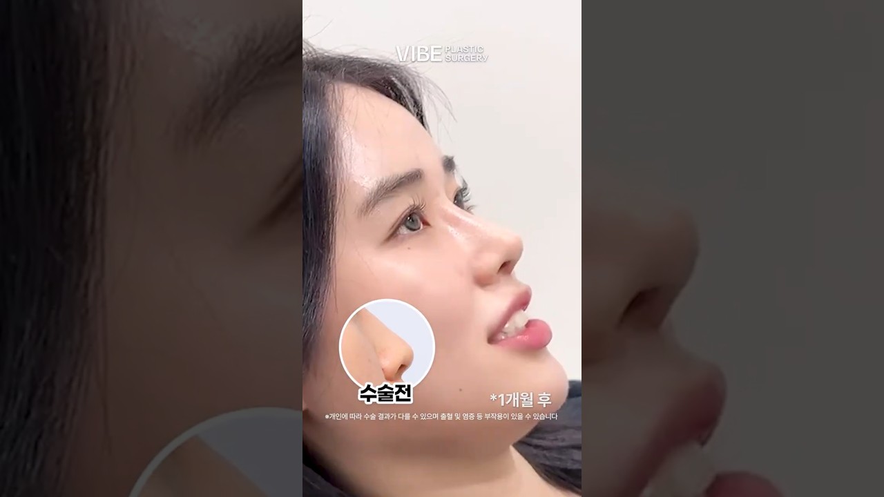 첫코 성형 대만족! 자꾸 입꼬리가 올라가요..♥️｜복코, 비순각, 코끝처짐 개선