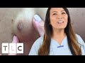 "It Kind Of Looked Like A Plum Coming Out" | Dr Pimple Popper: This is Zit