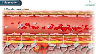 2. Vascular events of Acute Inflammation ( Animation )