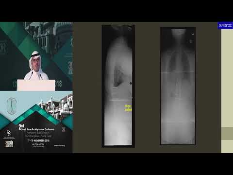 Proximal Junctional Complications in Long Segment Spine Fusion by Dr. Faisal Konbaz