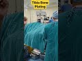 Tibia Bone Plating पैर की हड्डी का ऑपरेशन Mbbsmotivation Mbbs Su