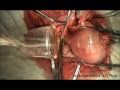 Total Abdominal Hysterectomy. Uterine Fibroids ...