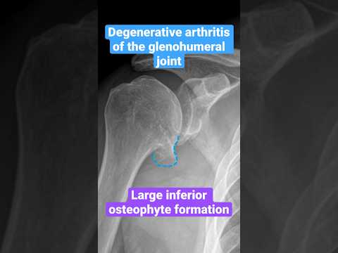 Degenerative arthritis (DJD) of the shoulder #shoulder #arthritis #radiology