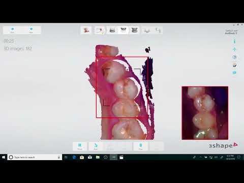 Tips & Tricks for Intra Oral Scanning