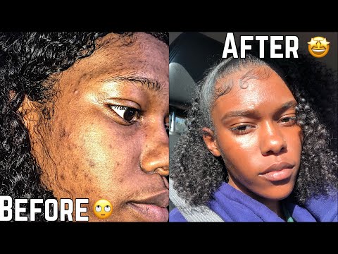 SKIN | How To Get Rid Of Hyperpigmentation (Dark...