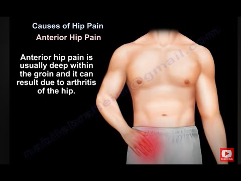 Hip pain -  Why does  it hurts? What causes the pain?  How is it treated ? is it hip arthritis?