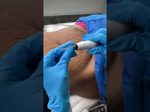 Stretch Marks Inkless Removal Boleyn Treatment Los Angeles  🌍 #shorts