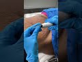 Stretch Marks Inkless Removal Boleyn Treatment Los Angeles Shorts