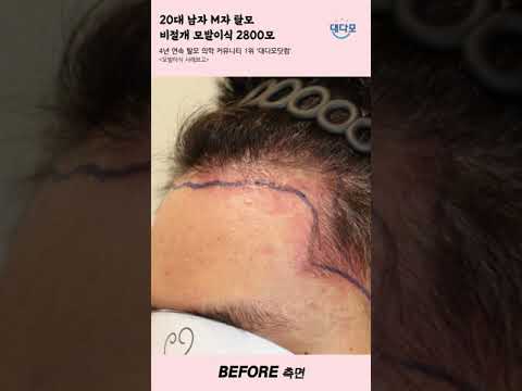 20多岁男性M型脱发, 非切开毛发移植 2800mo Before & After [#shorts]
