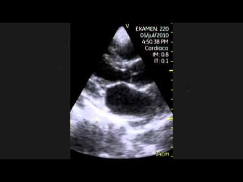 Echocardiography -  Parasternal Long-Axis View