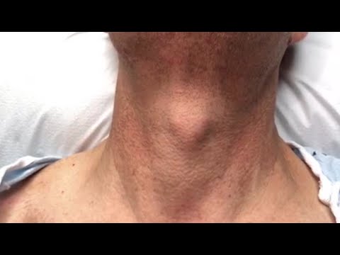 Jugular Venous Pulsations in Constrictive Pericarditis