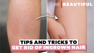 Tips & Tricks To Get Rid Of Ingrown Hair | Shaving Tips To Avoid Strawberry Legs | Be Beautiful