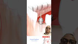 Dental Implant Front Tooth #shorts #dentalimplants #medicalasmr #medicalart