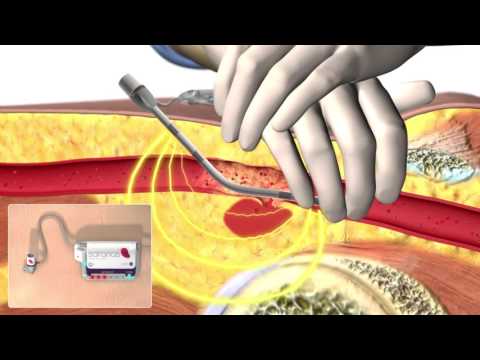 Saranas Kanari System